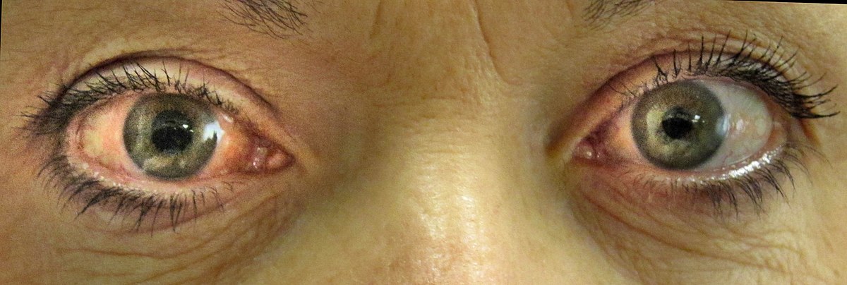 Glaucoma Kenya