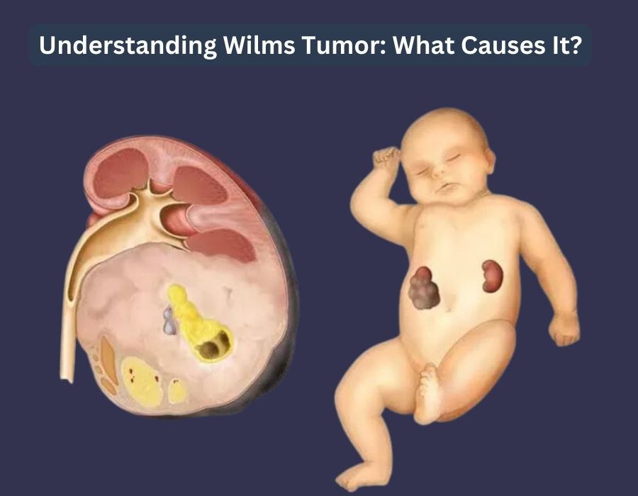 wilms tumor