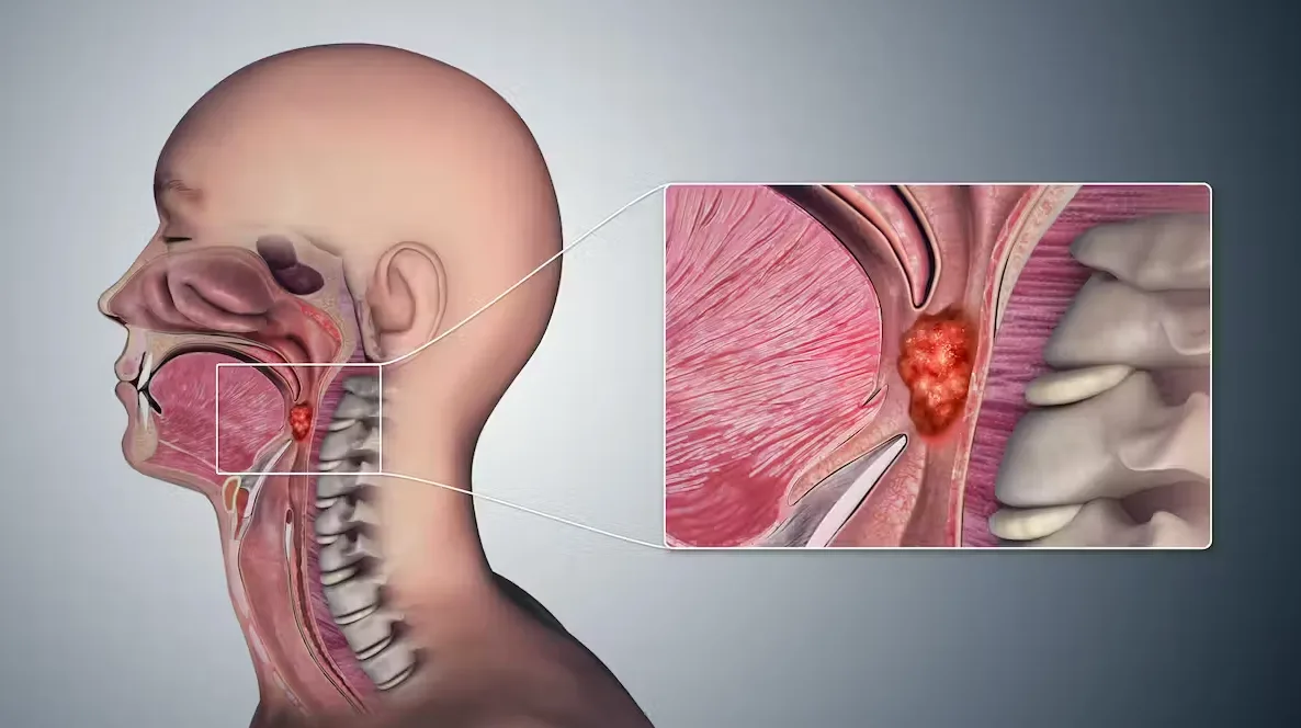 oral sex and throat cancer